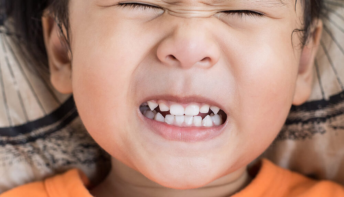 Teeth-Grinding-in-Children.jpg